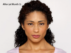 african-american-botox-before-and-after-best-torrance-botox