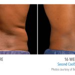 mens-coolsculpting-before-after-torrance-med-spa