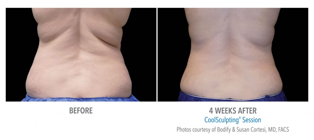 torrance-coolsculpting-back-flank-lower flank-coolsculpting2