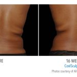 torrance-coolsculpting-back-flank-lower flank-coolsculpting5