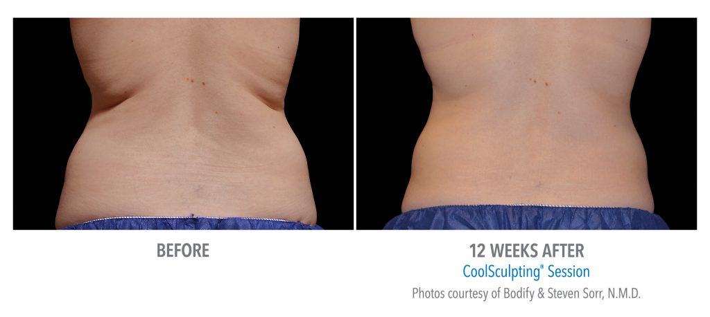 torrance-coolsculpting-back-flank-lower flank-coolsculpting6