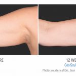 Coolsculpting-arm-Fat-in-whittier--150x150
