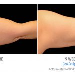 Coolsculpting-arms-whittier-150x150