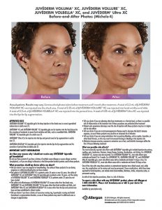Juvederm-before-after-Michele-232x300