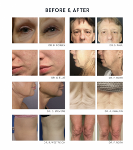 Morpheus8-microneedling-before-after-torrance-whittier-medical-spas-1-913x1024