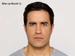 botox-before-after-caucasian-male-whittier-month3-300x226