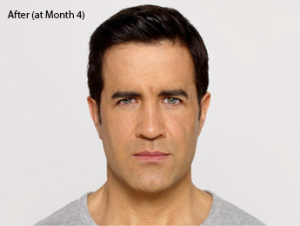 botox-before-after-caucasian-male-whittier-month4-300x226