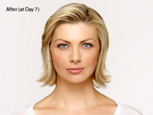 botox-before-and-after-caucasian-whittier-day7-300x226