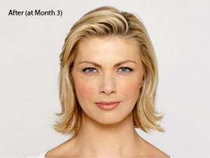 botox-before-and-after-caucasian-whittier-month3-300x226