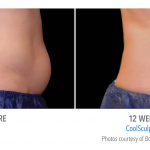 coolsculpting-stomach-fat-loss-150x150