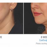 coolsculpting-under-chin-women-in-whittier-coolsculpting-150x150