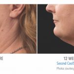 coolsculpting-under-chin-women-whittier-coolsculpting-150x150