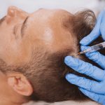 hair-loss-torrance-hair-restoration-treatment-near-me-150x150
