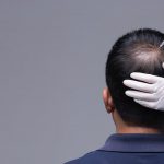 hair-restoration-torrance-hair-loss-treatment-med-spa-near-me-150x150