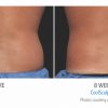 mens-coolsculpting-back-flank-in-whittier-100x100