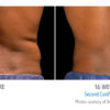 mens-coolsculpting-before-after-whittier-med-spa-100x100