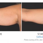 whittier-Coolsculpting-arm-Fat-150x150