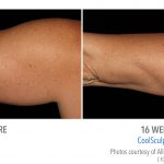 whittier-Coolsculpting-arm-Fat-los-150x150