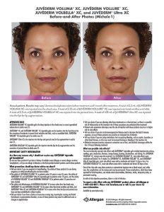 whittier-Juvederm-before-after-Michele-232x300