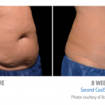 whittier-coolsculpting-stomach-150x150
