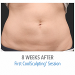 whittier-coolsculpting-stomach-fat-loss-150x150