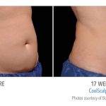 whittier-coolsculpting-stomach-weight-burn-150x150