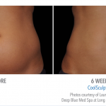 whittier-coolsculpting-stomach-weight-loss-150x150