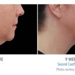 whittier-coolsculpting-under-chin-women-coolsculpting-150x150