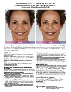 whittier-medical-Juvederm-before-after-Michele-232x300